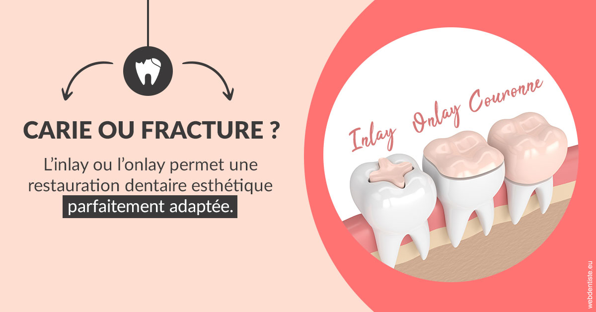 https://dr-chevrier-xavier.chirurgiens-dentistes.fr/T2 2023 - Carie ou fracture 2