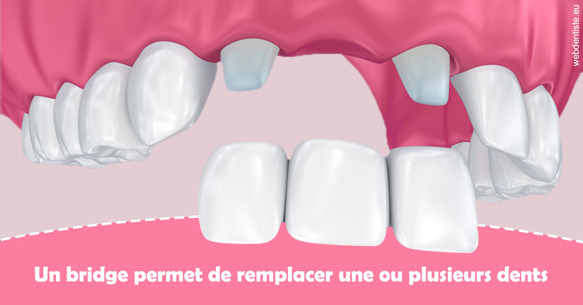https://dr-chevrier-xavier.chirurgiens-dentistes.fr/Bridge remplacer dents 2