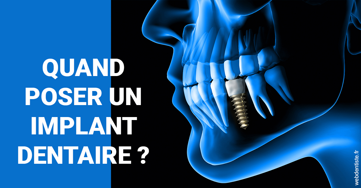 https://dr-chevrier-xavier.chirurgiens-dentistes.fr/Les implants 1
