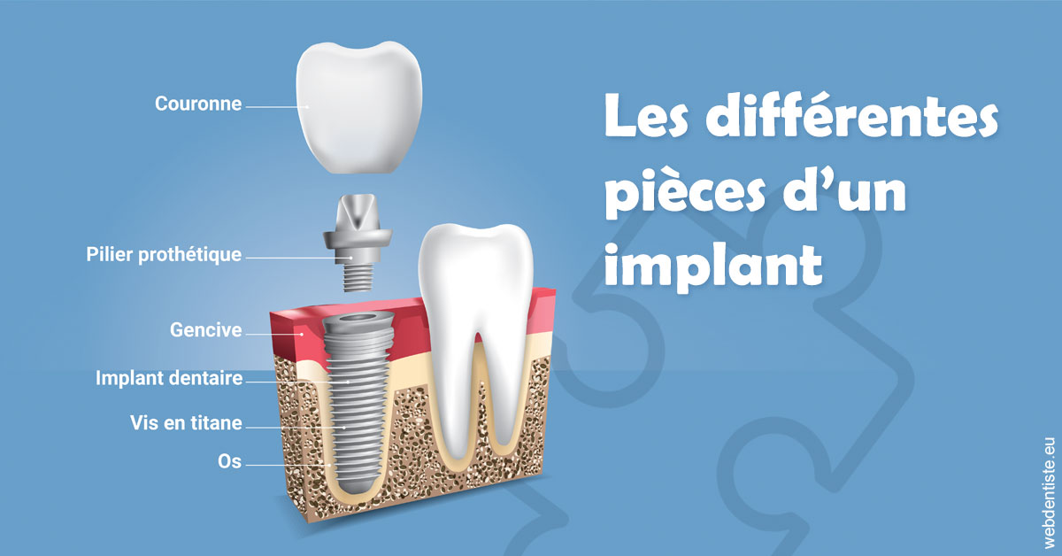https://dr-chevrier-xavier.chirurgiens-dentistes.fr/Les différentes pièces d’un implant 1